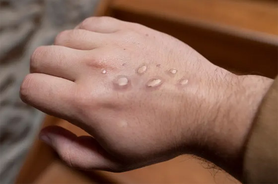 وسط تزايد إصابات جدري القرود.. قرار مرتقب للصحة العالمية صورة رقم 3 وسط تزايد إصابات جدري القرود.. قرار مرتقب للصحة العالمية صورة رقم 3