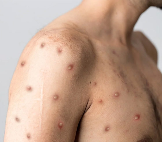 وسط تزايد إصابات جدري القرود.. قرار مرتقب للصحة العالمية صورة رقم 1 وسط تزايد إصابات جدري القرود.. قرار مرتقب للصحة العالمية صورة رقم 1