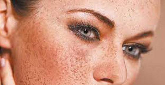 كيفية علاج الكلف بالنظام الغذائي صورة رقم 3