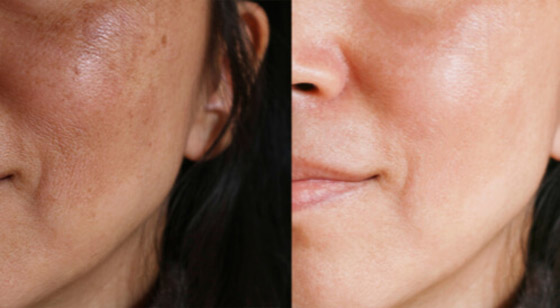 كيفية علاج الكلف بالنظام الغذائي صورة رقم 4