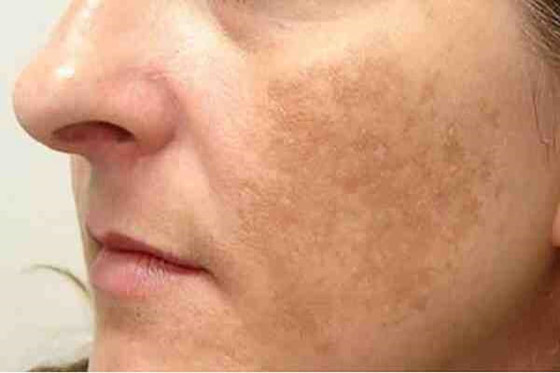 كيفية علاج الكلف بالنظام الغذائي صورة رقم 5