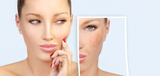 كيفية علاج الكلف بالنظام الغذائي صورة رقم 6