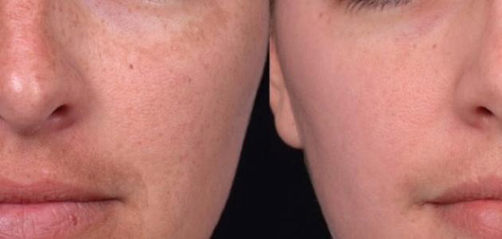 كيفية علاج الكلف بالنظام الغذائي صورة رقم 7