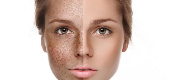 كيفية علاج الكلف بالنظام الغذائي صورة رقم 8