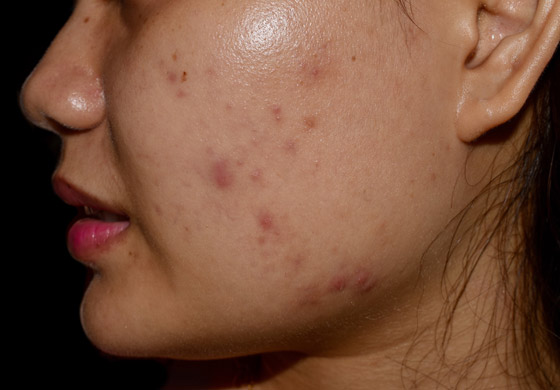 هكذا يمكنكم إزالة آثار الحبوب من البشرة باستخدام مكونات طبيعية صورة رقم 7 هكذا يمكنكم إزالة آثار الحبوب من البشرة باستخدام مكونات طبيعية صورة رقم 7