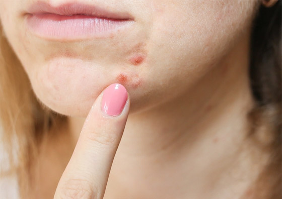 هكذا يمكنكم إزالة آثار الحبوب من البشرة باستخدام مكونات طبيعية صورة رقم 2 هكذا يمكنكم إزالة آثار الحبوب من البشرة باستخدام مكونات طبيعية صورة رقم 2