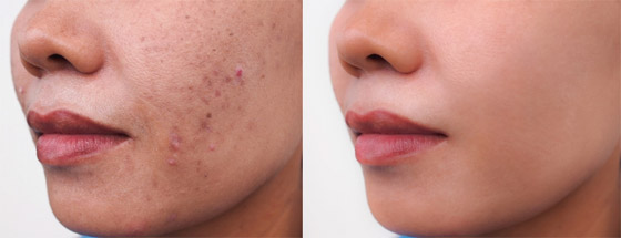 هكذا يمكنكم إزالة آثار الحبوب من البشرة باستخدام مكونات طبيعية صورة رقم 1 هكذا يمكنكم إزالة آثار الحبوب من البشرة باستخدام مكونات طبيعية صورة رقم 1