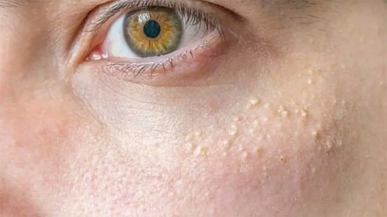 هكذا تتخلصون من الزيوان الأبيض الذي يغزو البشرة صورة رقم 1 هكذا تتخلصون من الزيوان الأبيض الذي يغزو البشرة صورة رقم 1