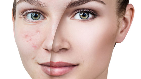 المعاناة من حب الشباب.. 5 أخطاء شائعة نرتكبها صورة رقم 4