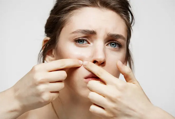 المعاناة من حب الشباب والبثور.. 5 أخطاء شائعة نرتكبها! صورة رقم 3 المعاناة من حب الشباب والبثور.. 5 أخطاء شائعة نرتكبها! صورة رقم 3