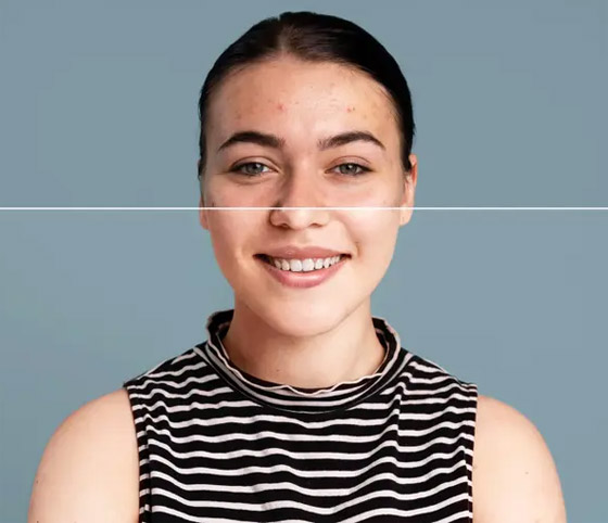 المعاناة من حب الشباب والبثور.. 5 أخطاء شائعة نرتكبها! صورة رقم 2 المعاناة من حب الشباب والبثور.. 5 أخطاء شائعة نرتكبها! صورة رقم 2