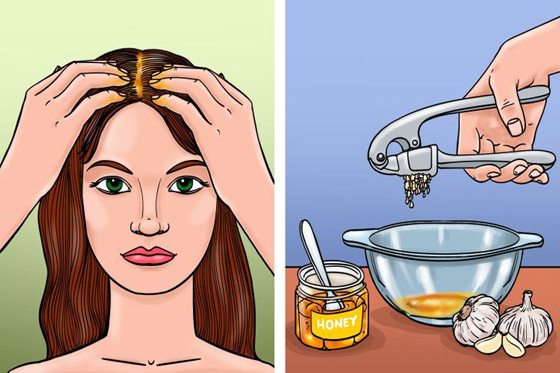 اليكم افضل 5 وصفات لمكافحة قشرة الرأس صورة رقم 6 اليكم افضل 5 وصفات لمكافحة قشرة الرأس صورة رقم 6