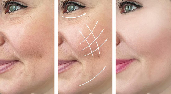 طرق بسيطة لإخفاء التجاعيد.. إذا كنتِ فوق الأربعين صورة رقم 4