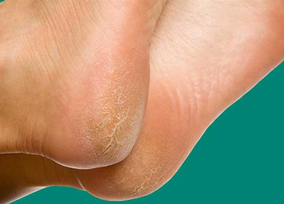 وصفتان طبيعيتان لعلاج تشقق الكعبين صورة رقم 3