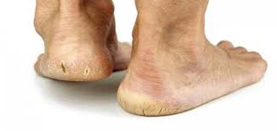 وصفتان طبيعيتان لعلاج تشقق الكعبين صورة رقم 4