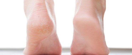 وصفتان طبيعيتان لعلاج تشقق الكعبين صورة رقم 5