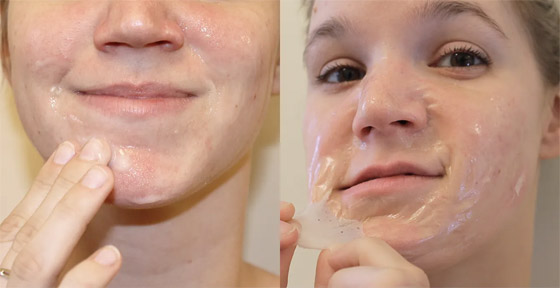 كيفية التخلص من الرؤوس السوداء على الذقن..؟ صورة رقم 3 كيفية التخلص من الرؤوس السوداء على الذقن..؟ صورة رقم 3