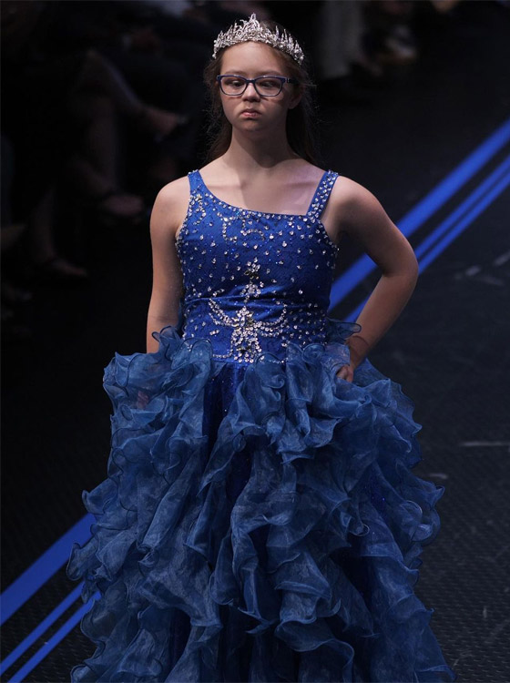 مراهقة مصابة بمتلازمة 