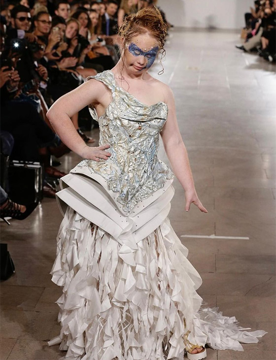 مراهقة مصابة بمتلازمة 