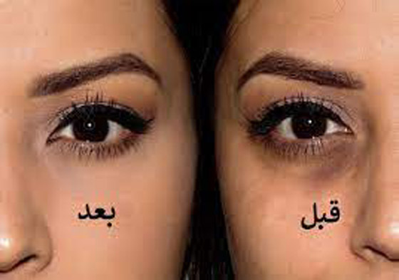 تقليل الملح إحداها.. طرق طبيعية للتخلص من الهالات السوداء صورة رقم 4