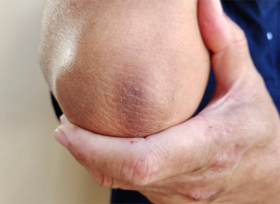 قللوا عدد مرات الاستحمام.. أسباب جفاف الجلد وطرق علاجه صورة رقم 7