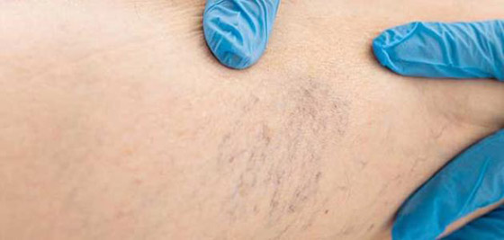 الأوردة العنكبوتية تفسد جمال سيقانك؟ هكذا تتخلصين منها صورة رقم 2