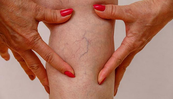 الأوردة العنكبوتية تفسد جمال سيقانك؟ هكذا تتخلصين منها صورة رقم 3