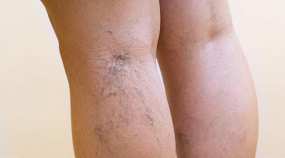 الأوردة العنكبوتية تفسد جمال سيقانك؟ هكذا تتخلصين منها صورة رقم 4