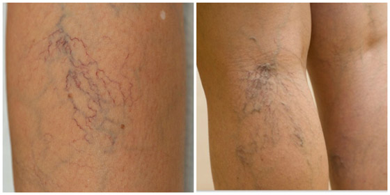 الأوردة العنكبوتية تفسد جمال سيقانك؟ هكذا تتخلصين منها صورة رقم 6