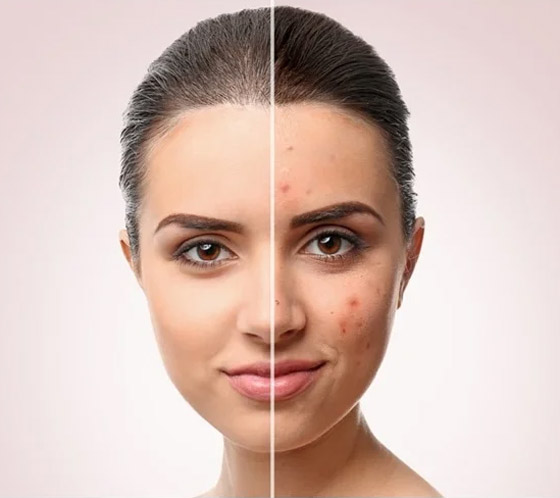 7 مجموعات أطعمة فعالة جدا في محاربة حب الشباب.. ما هي؟ صورة رقم 8 7 مجموعات أطعمة فعالة جدا في محاربة حب الشباب.. ما هي؟ صورة رقم 8