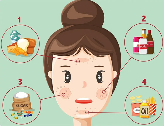 7 مجموعات أطعمة فعالة جدا في محاربة حب الشباب.. ما هي؟ صورة رقم 10 7 مجموعات أطعمة فعالة جدا في محاربة حب الشباب.. ما هي؟ صورة رقم 10