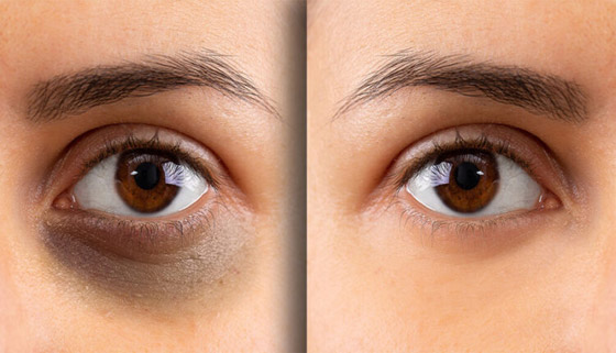 تخلصي من الهالات السوداء.. على الطريقة الكورية صورة رقم 5