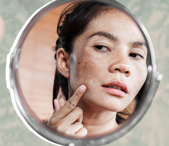 ما المكونات التي أثبتت فعاليتها في علاج البقع الداكنة؟ صورة رقم 3