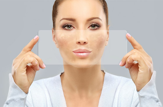 التقشير الكيميائي للجلد.. تعرفوا على أنواعه وفوائده وأضراره المحتملة صورة رقم 1