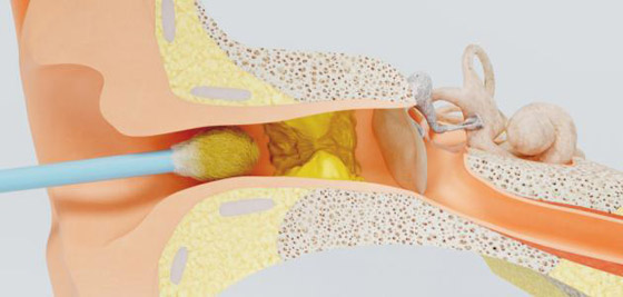 6 مؤشرات على ضرورة إزالة الشمع الزائد من أذنيك صورة رقم 2