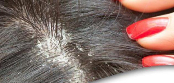 قشرة الرأس المزعجة.. أشهر أنواعها وكيفية علاجها صورة رقم 6