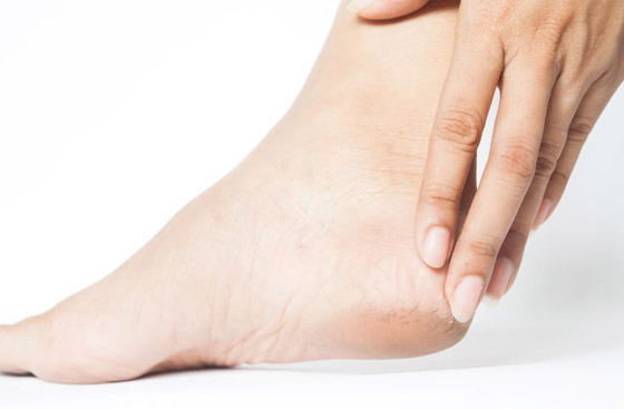 علاج تشقق القدمين في يومين فقط بالمكونات الطبيعية صورة رقم 1 علاج تشقق القدمين في يومين فقط بالمكونات الطبيعية صورة رقم 1