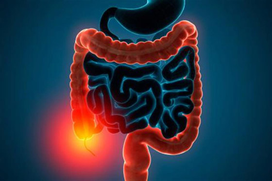 أفضل العصائر لتخفيف أعراض التهاب القولون التقرحي صورة رقم 1 أفضل العصائر لتخفيف أعراض التهاب القولون التقرحي صورة رقم 1