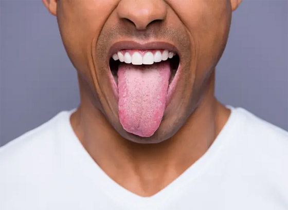 لسانك مرآة صحتك العامة.. إليك الأسباب والأعراض لوجود مشاكل صورة رقم 3