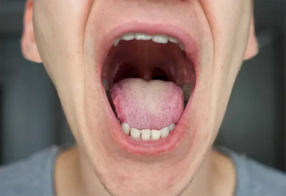لسانك مرآة صحتك العامة.. إليك الأسباب والأعراض لوجود مشاكل صورة رقم 5