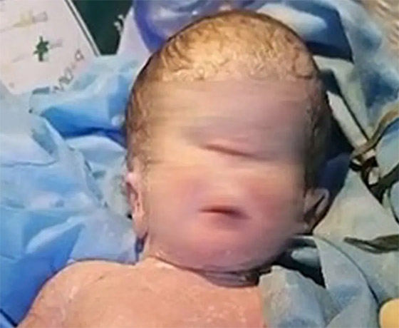 صورة رقم 1 - صور صادمة لولادة طفل بعين واحدة في العراق.. والطب يوضح صورة رقم 1 - صور صادمة لولادة طفل بعين واحدة في العراق.. والطب يوضح