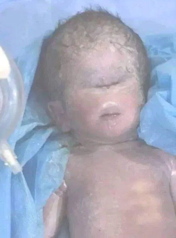 صورة رقم 2 - صور صادمة لولادة طفل بعين واحدة في العراق.. والطب يوضح صورة رقم 2 - صور صادمة لولادة طفل بعين واحدة في العراق.. والطب يوضح