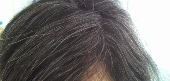 هل هناك علاج حقيقي لشيب الشعر؟.. إليك الإجابة صورة رقم 7