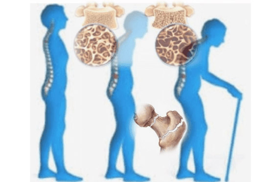 هشاشة العظام ..أسبابها وطرق مكافحتها صورة رقم 1