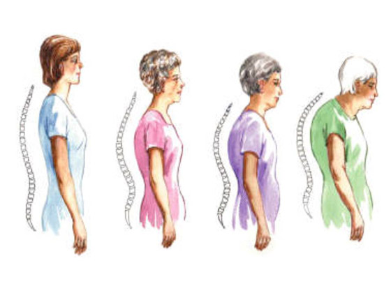 هشاشة العظام ..أسبابها وطرق مكافحتها صورة رقم 5