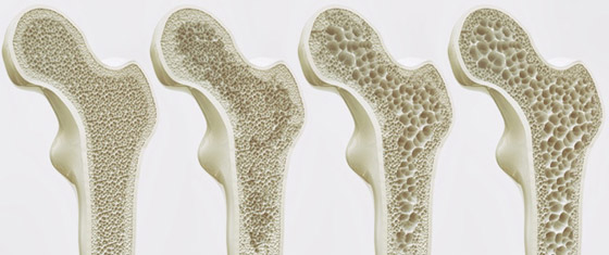 هشاشة العظام ..أسبابها وطرق مكافحتها صورة رقم 6