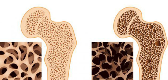 هشاشة العظام ..أسبابها وطرق مكافحتها صورة رقم 7