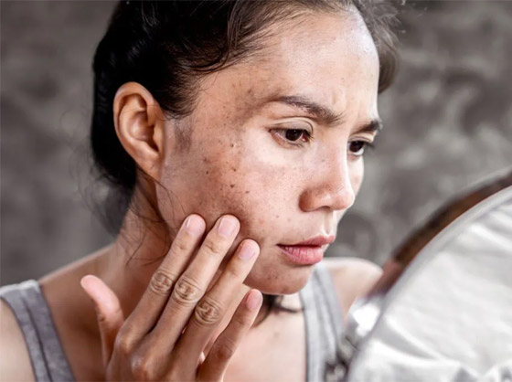 هذه أغرب المكونات المزيلة للبقع الداكنة.. هل تعرفونها؟ صورة رقم 6