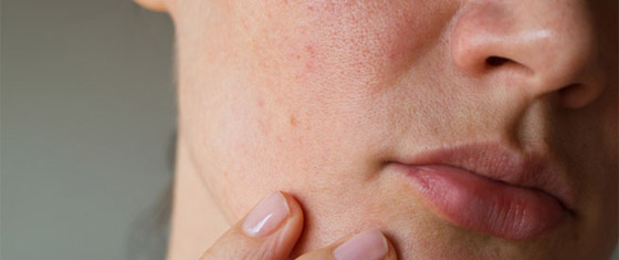 هكذا تمنعين تفاعلات الحساسية الناتجة عن منتجات العناية بالبشرة صورة رقم 6