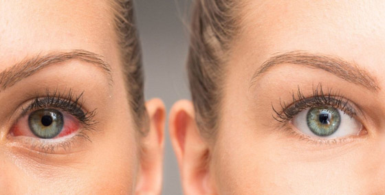 حماية العينين في فصل الصيف.. ضرورية لتجنّب الحروق والعمى صورة رقم 4